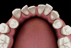a 3D depiction of a crowded smile