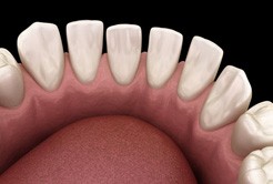 a 3D example of gaps between teeth
